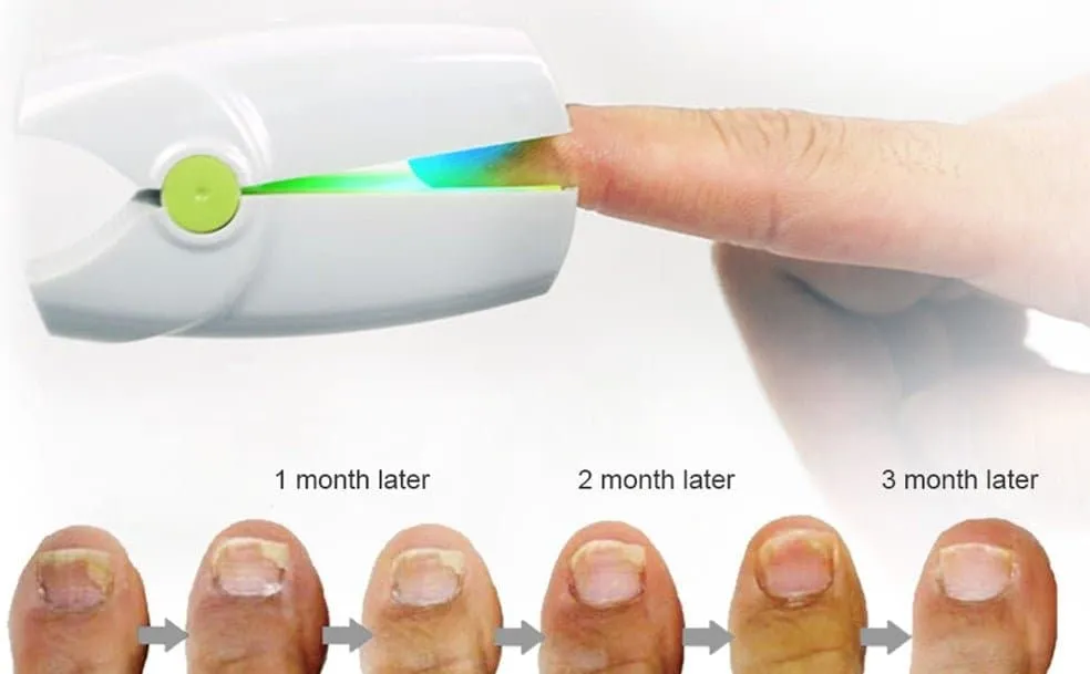 Portable Fungus Nail Laser