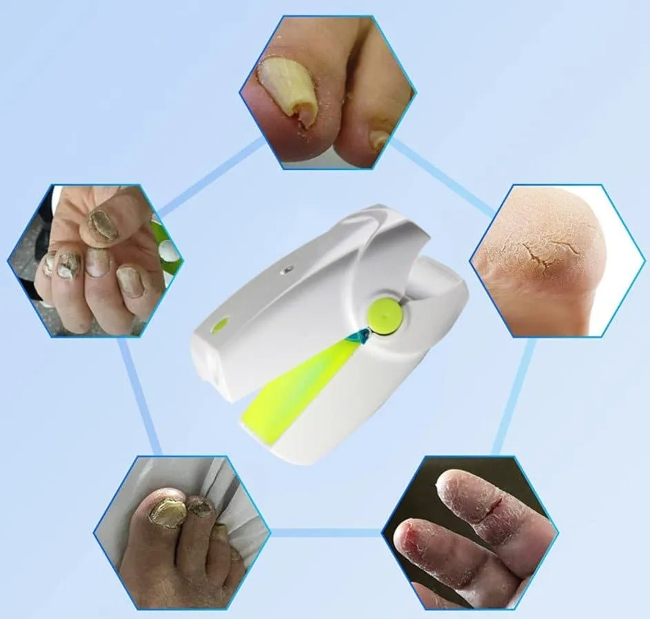 Portable Fungus Nail Laser